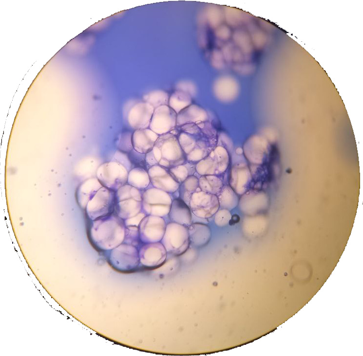 lipoma.png